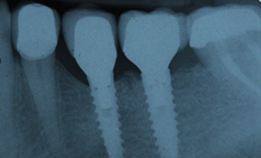 Implantes