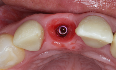 Implantes_2
