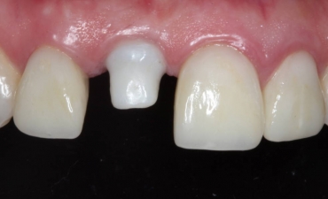 Implantes_3