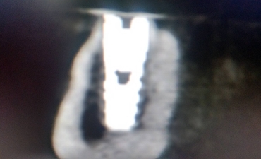 Implantes_5